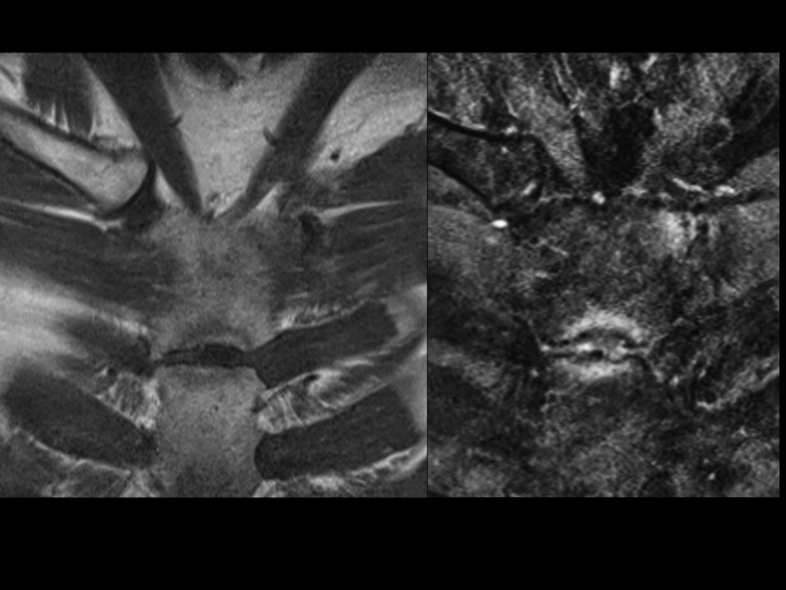 Figure 1 for case manubrium ( RID2476 )